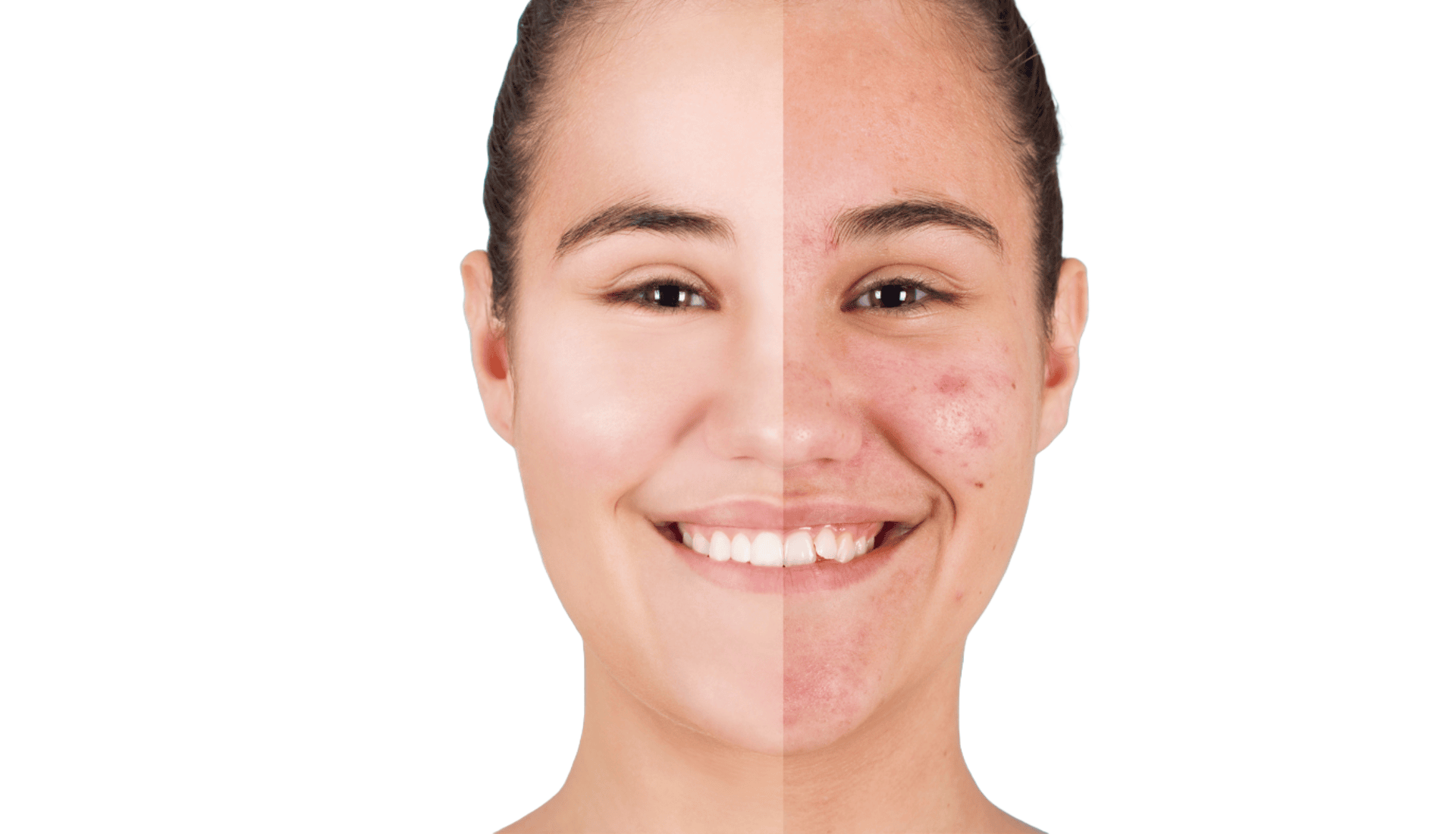 Acne Facial Treatments for Adults