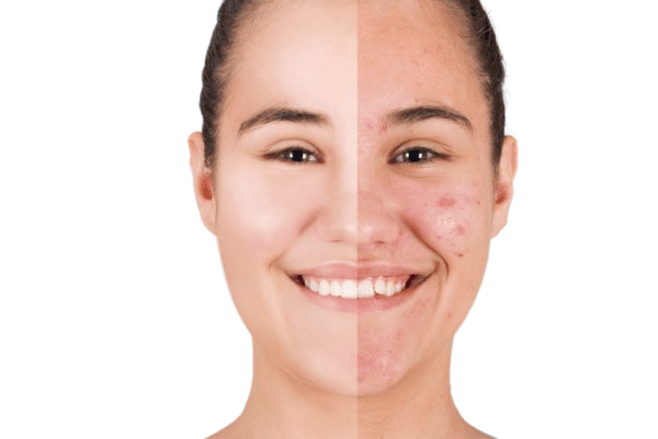 Adult-Acne-at-30-Years-Old-removebg-preview.webp