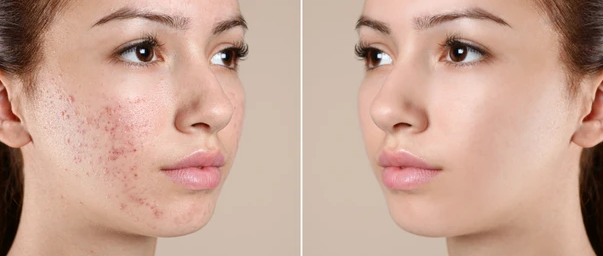Teen-Facial-for-Acne-girl-1.webp