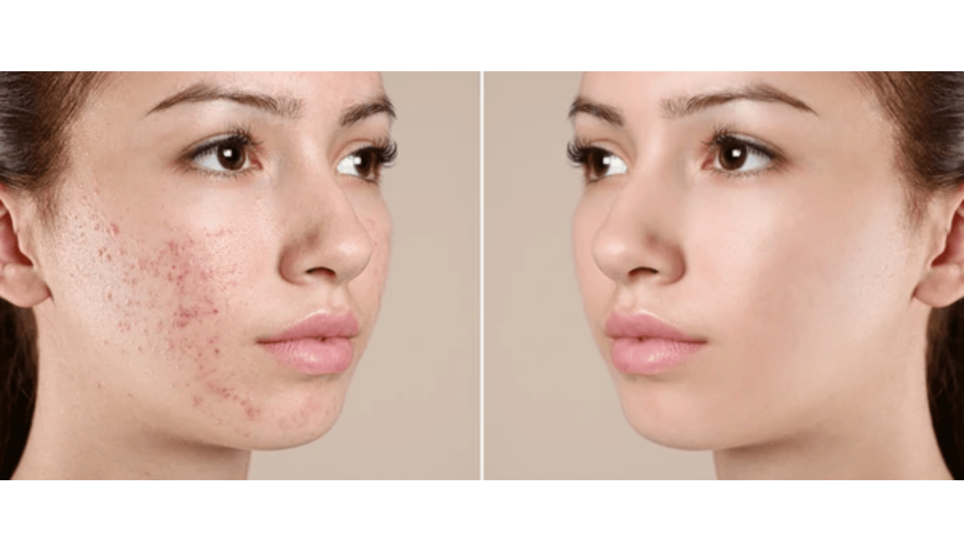 Facial Treatments for Young Ladies (Teens)